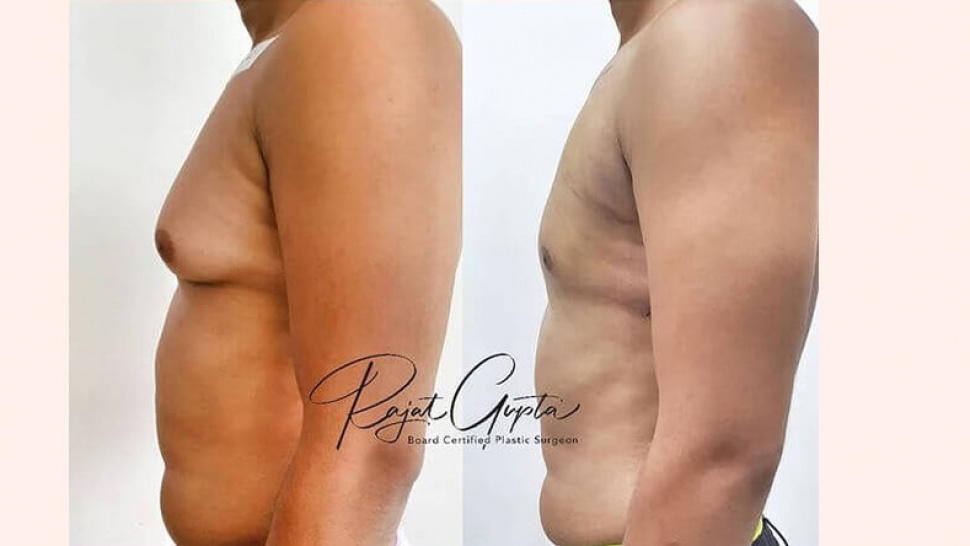 Gynecomastia Surgery Consultation Online – How to Prepare