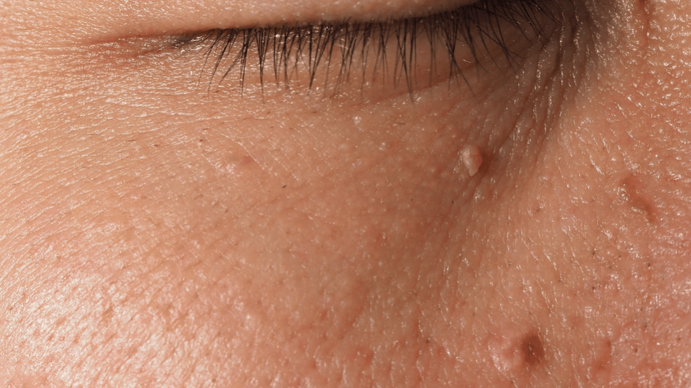 Who should consider Salicylic Acid Peel Treatment?
