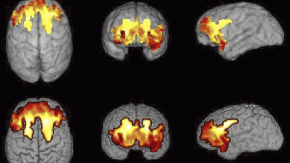 Rich and Poor Children Brain Morphology Difference