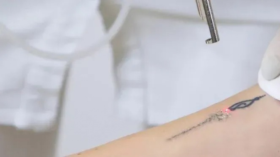 Laser Tattoo Removal Near Me Altamonte Springs
