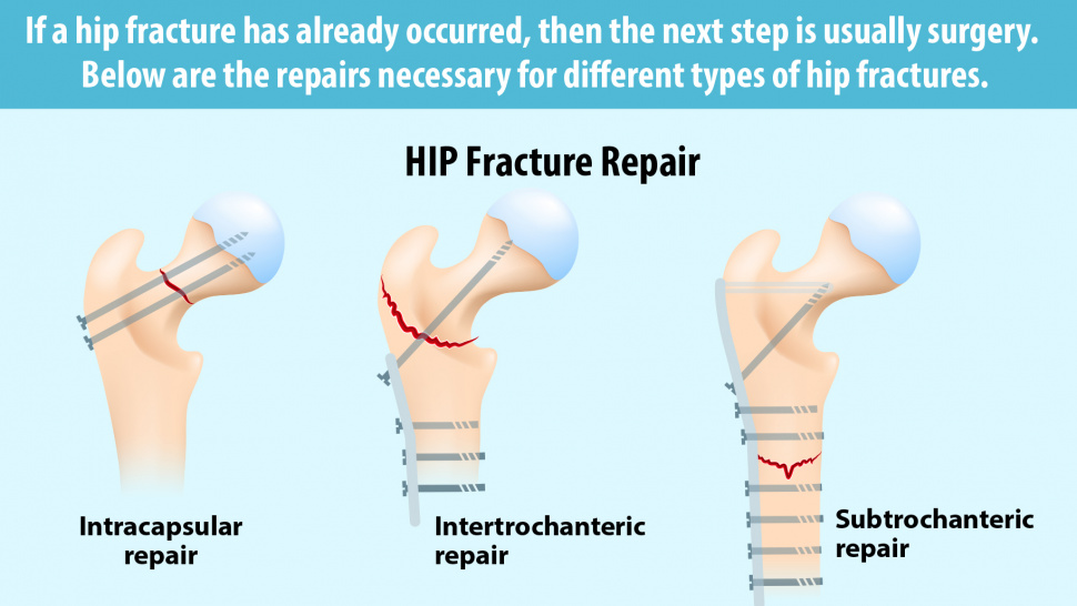 Hip Fracture? Here Are 3 Surgical Ways To An Effective Treatment