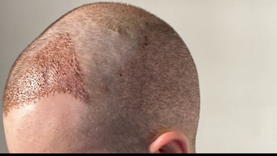 What medical tests are required before a hair transplant?