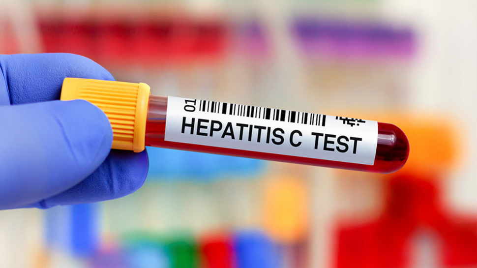 How Is Hepatitis C Viral Load Tested?