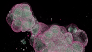 Beyond CAR-T: Why CIK Cells Are the Next Frontier in Cancer Immunotherapy