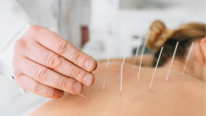 Dry Needling NYC
