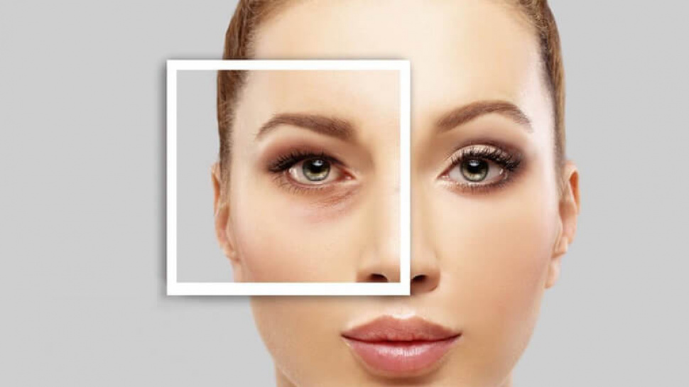 Who is an Ideal Candidate for Lower Blepharoplasty Surgery?