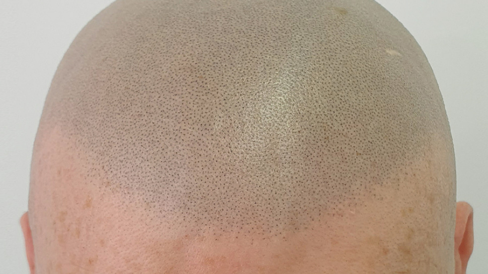 What is Scalp Micropigmentation Treatment?