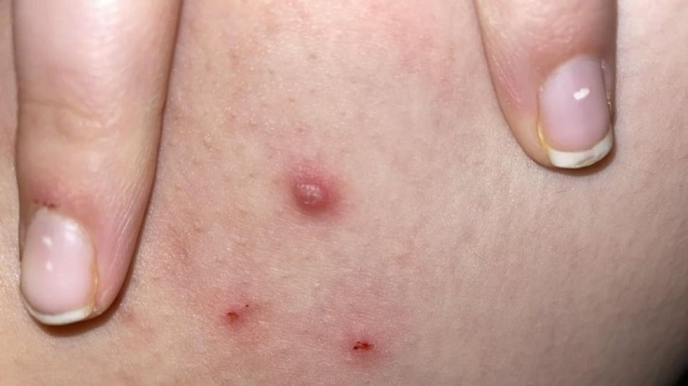 How can you estimate the total cost of wart removal?